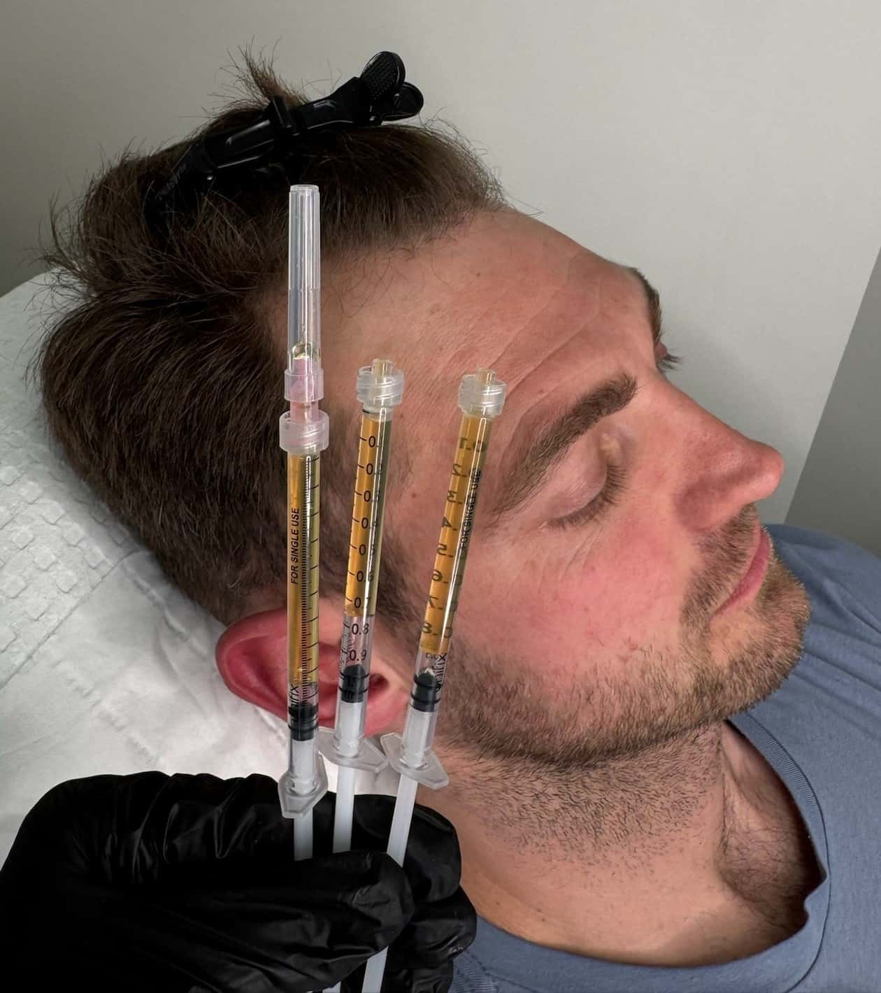 PRP Menshair Hairline